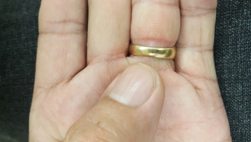 Bulging flesh above tight ring